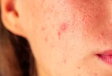 علاج حب الشباب وطرق الوقاية منه 27 علاج حب الشباب وطرق الوقاية وأسباب ظهورة