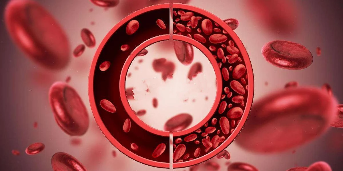 علاج فقر الدم ( الأنيميا ) وأنواعها التي يتعرض لها الإنسان 1 علاج فقر الدم