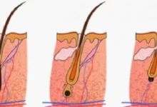 نمو الشعر وأسباب وعلاج التقصف 30 نمو الشعر