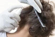 علاج القمل والصيبان في شعر الرأس والإبط