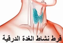 أسباب وأعراض فرط نشاط الغدة الدرقية ومضاعفاتها 26 فرط نشاط الغده الدرقية