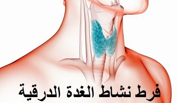 أسباب وأعراض فرط نشاط الغدة الدرقية ومضاعفاتها 1 فرط نشاط الغده الدرقية