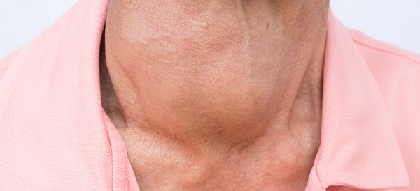 أسباب وأعراض فرط نشاط الغدة الدرقية ومضاعفاتها 2 الأسباب والأعراض | فرط نشاط الغده الدرقية ومضاعفاتها