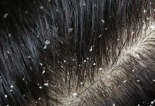 قشرة الشعر أسبابها وطرق التعامل معها 20 قشرة الشعر أسبابها وطرق التعامل معها