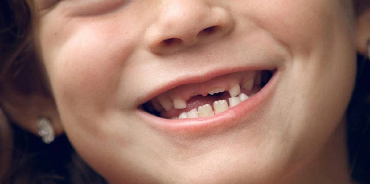 6 أسباب لتساقط الأسنان وكيفية الحفاظ عليها