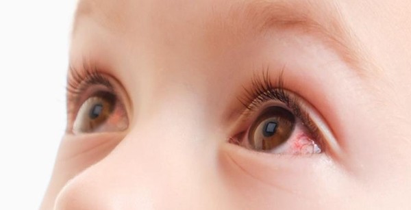 احمرار العين عند الأطفال و 9 طرق للوقاية
