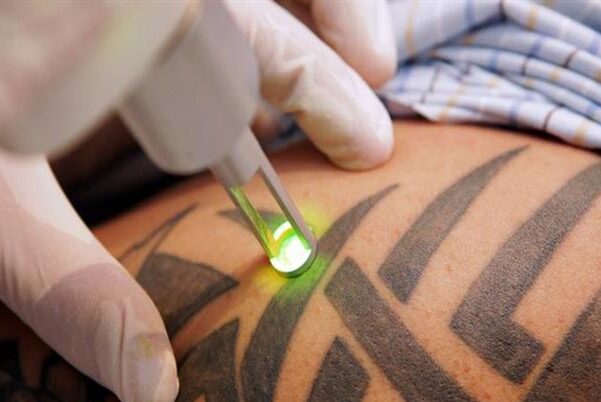 اهم طرق إزالة الوشم 4 طرق إزالة الوشم