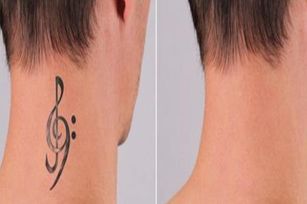 اهم طرق إزالة الوشم 2 طرق إزالة الوشم