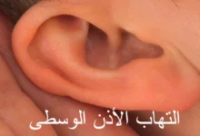التهاب الأذن الوسطى