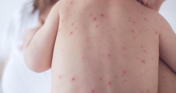 النخالة الوردية وأهم 5 أعراض لها 2 النخالة الوردية