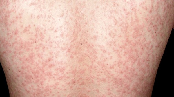 النخالة الوردية وأهم 5 أعراض لها 3 النخالة الوردية