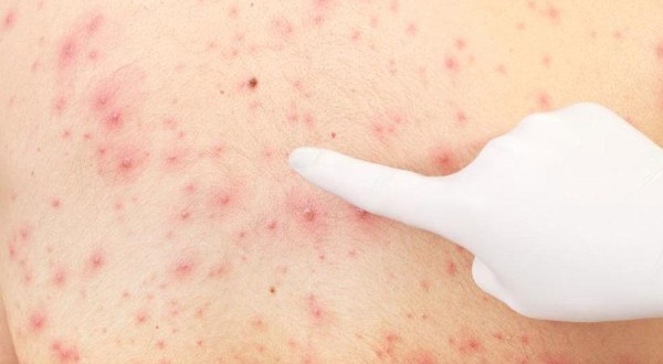 النخالة الوردية وأهم 5 أعراض لها 4 النخالة الوردية