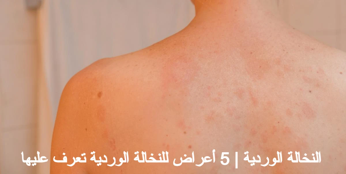 النخالة الوردية وأهم 5 أعراض لها 1 النخالة الوردية