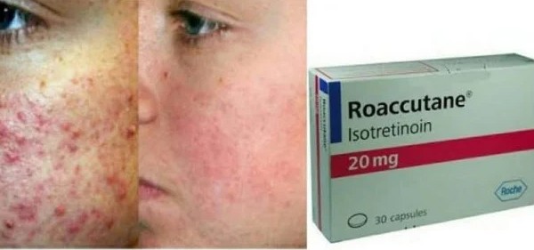 حبوب الروكتان لعلاج حب الشباب و الآثار الجانبية Roaccutane 3 حبوب الروكتان لعلاج حب الشباب