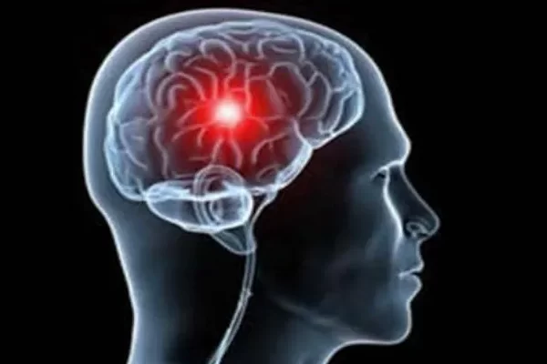 السكتة الدماغية و 14 سبب يصيبك بها 4 السكتة الدماغية