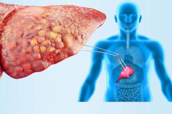 10 أسباب تؤدي إلى مرض تشمع الكبد 2 مرض تشمع الكبد