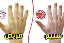 فقر الدم بسبب نقص الحديد وأعراضه وعلاجه 28 فقر الدم بسبب نقص الحديد