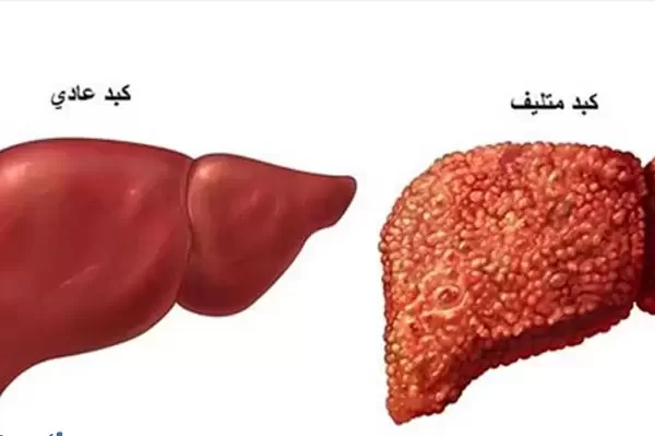 10 أسباب تؤدي إلى مرض تشمع الكبد 3 مرض تشمع الكبد
