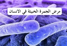 هل مرض الجمرة الخبيثة مرض مميت؟ 26 مرض الجمرة الخبيثة