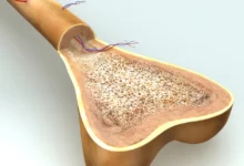 التصلب النخاعي تليف وتصلب نخاع العظم 20 التصلب النخاعي