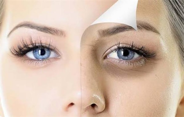 علاج الهالات السودة تحت العين بطرق طبيعية 3 علاج الهالات السودة