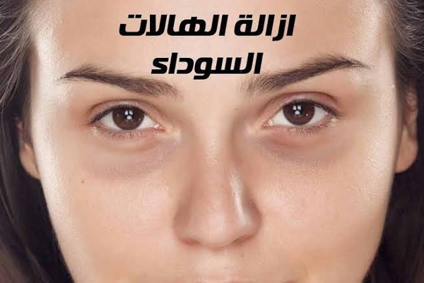 علاج الهالات السودة تحت العين بطرق طبيعية 2 علاج الهالات السودة