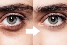 علاج الهالات السودة تحت العين بطرق طبيعية 27 علاج الهالات السودة