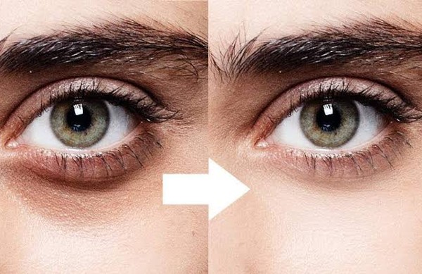 علاج الهالات السودة تحت العين بطرق طبيعية 1 علاج الهالات السودة