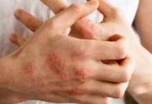 أعراض الأكزيما وعلاجها 20 أعراض الأكزيما وعلاجها