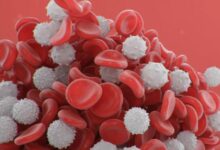 اللوكيميا مرض يصيب خلايا الدم الحمراء صح ام خطأ ؟ 28 اللوكيميا مرض يصيب خلايا الدم الحمراء صح ام خطأ ؟