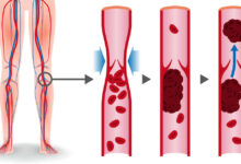 تجربتي مع جلطة الساق الاسباب والاعراض 25 تجربتي مع جلطة الساق