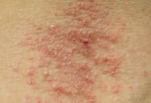 مرض الإكزيما الأعراض والعلاج والاسباب 25 مرض الإكزيما الأعراض والعلاج