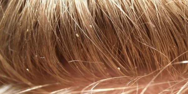 شامبو كلاينز لعلاج القمل نهائيا 2 شامبو كلاينز لعلاج القمل