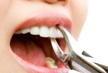 تفسير حلم خلع الطاحونة في المنام 27 تفسير حلم خلع الطاحونة