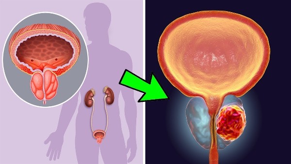 علاج البروستاتا بالأعشاب وفوائد البصل في علاجها 3 علاج البروستاتا بالأعشاب