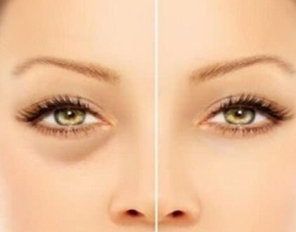 ماسك الهالات السوداء الفعال 4 ماسك الهالات السوداء