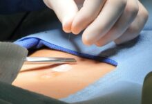 كيف أعرف أن عملية الفتاق قد نجحت ؟ 27 عملية الفتاق